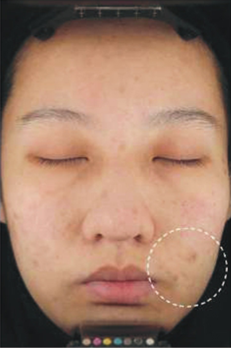 After skin treatment