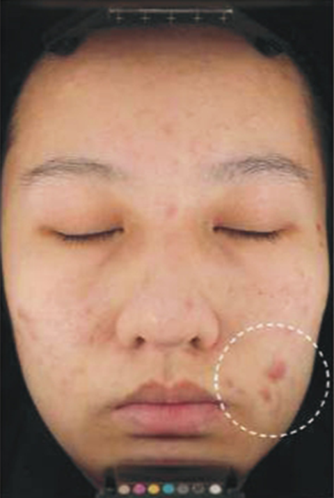 Before skin treatment